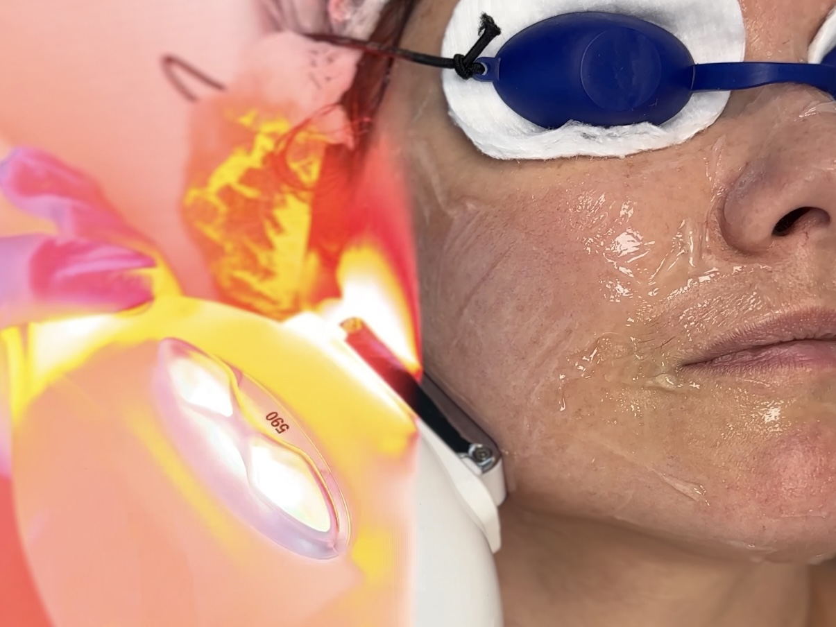 Laserowe usuwanie przebarwień – skuteczna metoda na jednolitą cerę !